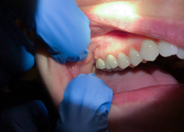 Best Emergency Wisdom Teeth Removal in Rainier, WA